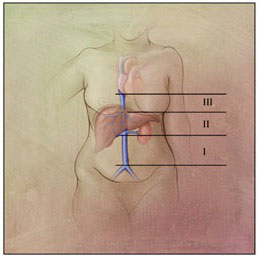 Primary tumor of the IVC